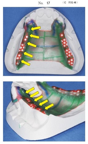 義歯製作中のある過程の写真