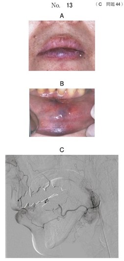 口腔外写真、口腔内写真及び術前の選択的血管造影像