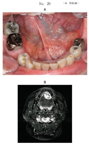 口腔内写真、MRI脂肪抑制T2強調像