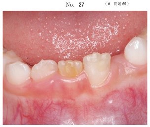 下顎右側中切歯の色調異常の口腔内写真