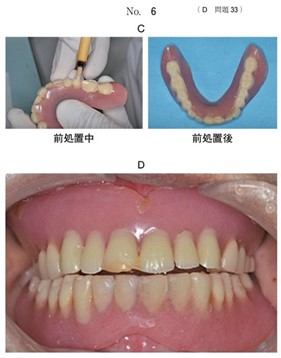 前処置中と前処置後の旧義歯の写真及び前処置後の旧義歯装着時の口腔内写真