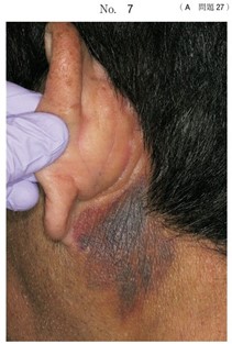 交通外傷で搬送された患者の耳部の写真