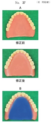 修正前後の義歯の写真と修正中のある技工操作の写真