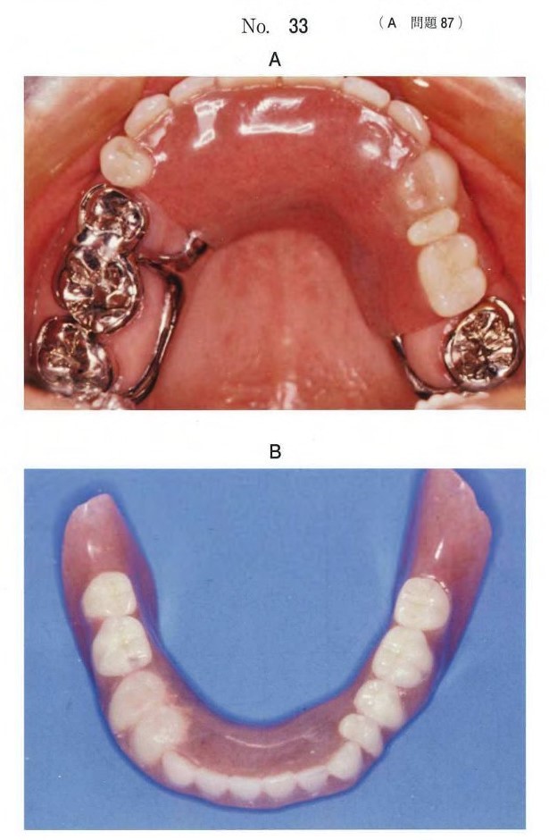 上顎義歯装着時の口腔内写真、下顎義歯の写真