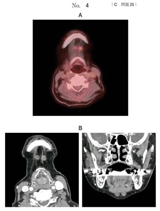 下顎歯肉癌患者のFDG-PET_CTと造影CT