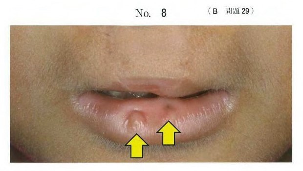 両側性唇顎口蓋裂の女児の顔貌写真