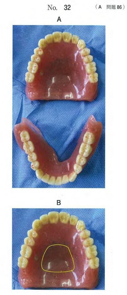 咬合接触状態を印記した義歯の写真と食物の残留部位を示す写真