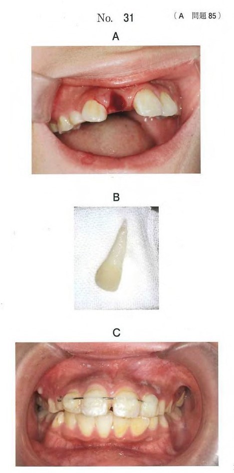 小児の口腔内写真、脱落した歯の写真、及び処置後の口腔内写真
