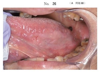 舌の白斑を主訴として来院した患者の口腔内写真