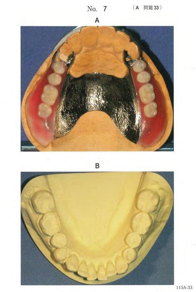 過程の写真と下顎歯列模型の写真