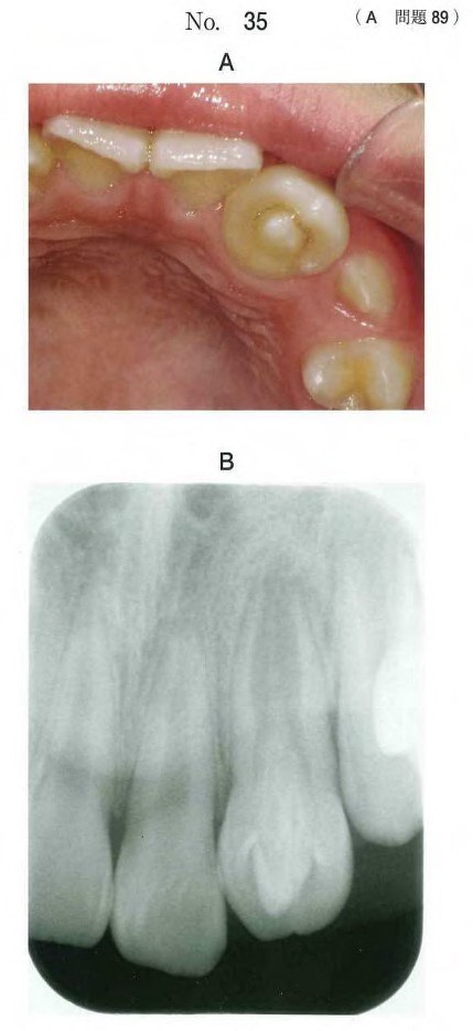 患者の口腔内写真とエックス線画像