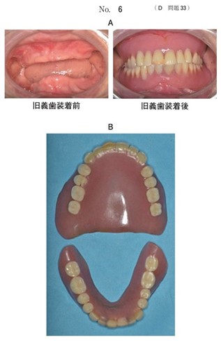 旧義歯装着前後の口腔内写真、旧羲歯の写真