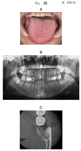 舌の写真、エックス線画像及び-P部の歯科用コーンビームCT