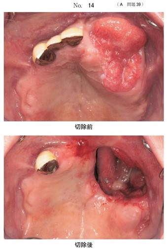 上顎腫瘍切除前後の口腔内写真