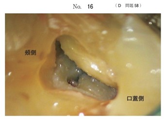 上顎右側第二大臼歯の抜髄治療中のマイクロスコープ写真