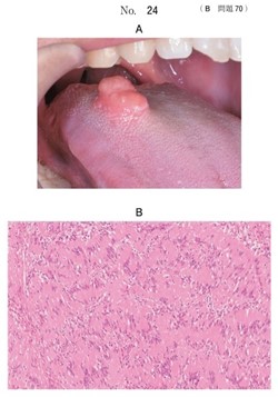 口腔内写真と切除時のΗ-E染色病理組織像