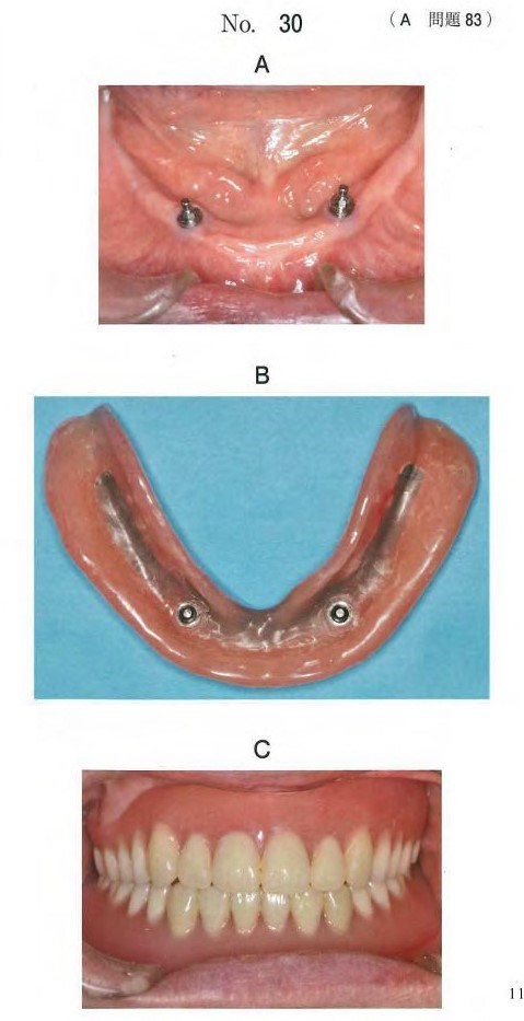 インプラン卜埋入6か月後の口腔内写真、下顎義歯の写真及び上下顎義歯装着時の口腔内写真