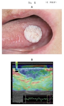 口腔内写真とある口腔内検査の画像