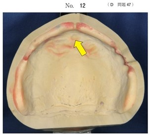 無歯顎患者の作業用模型の写真
