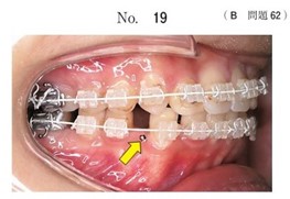 矯正歯科治療中の口腔内写真