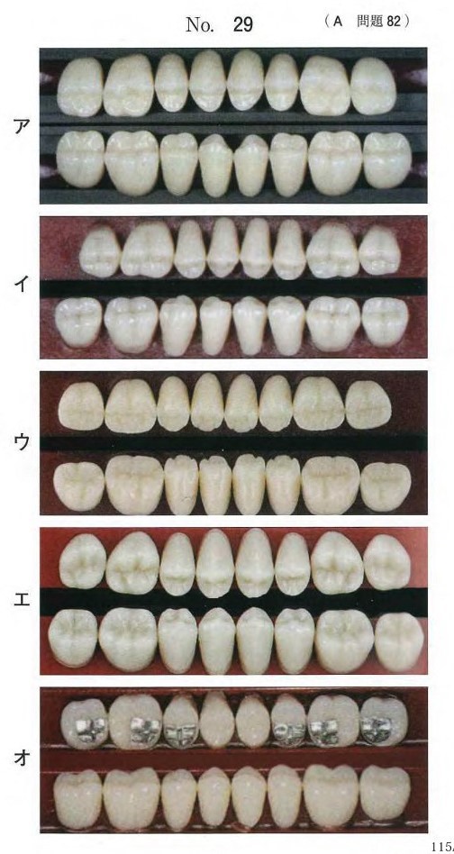 臼歯部人工歯の写真