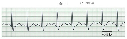 ある患者の心電図