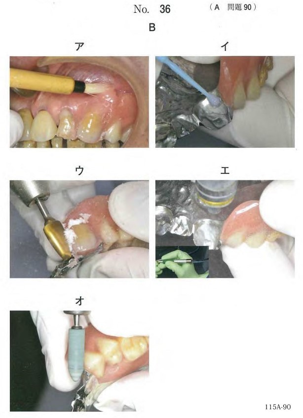 義歯修理時における一連の操作の写真