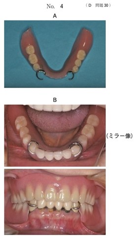 装着した下顎治療用義歯の写真と上下顎治療用義歯装着時の口腔内写真