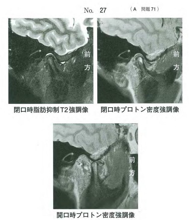 患者の右側顎関節部MRI