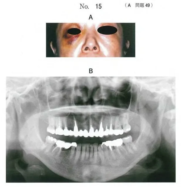歯科医師国家試験 第115回 A49問題 | 歯科国試ドットコム
