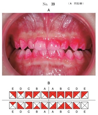 歯垢染色後の口腔内写真とその結果のチャート