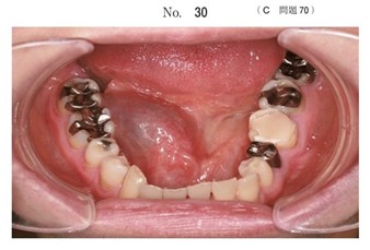 口底に腫脹と消退を繰り返す病変の口腔内写真