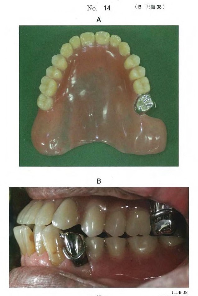 義歯の写真と装着時の口腔内写真