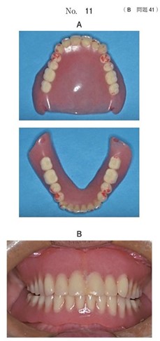 使用中の義歯の写真と義歯装着時の口腔内写真
