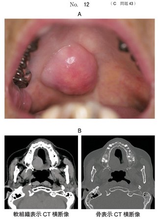 口蓋部の腫脹を主訴として来院した患者の初診時の口腔内写真と CT