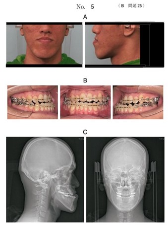 術前矯正治療終了時の顔面写真、口腔内写真及び側面と正面頭部エックス線規格写真