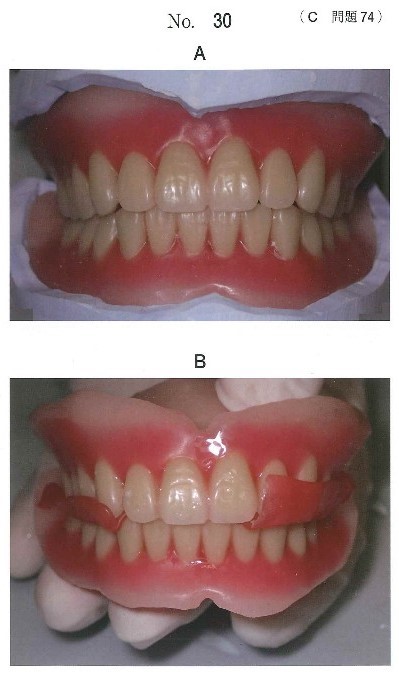 ろう義歯の写真とチェックバイト採得後の写真