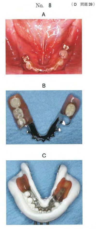 口腔内写真、義歯の写真、及び修理時のある過程の写真