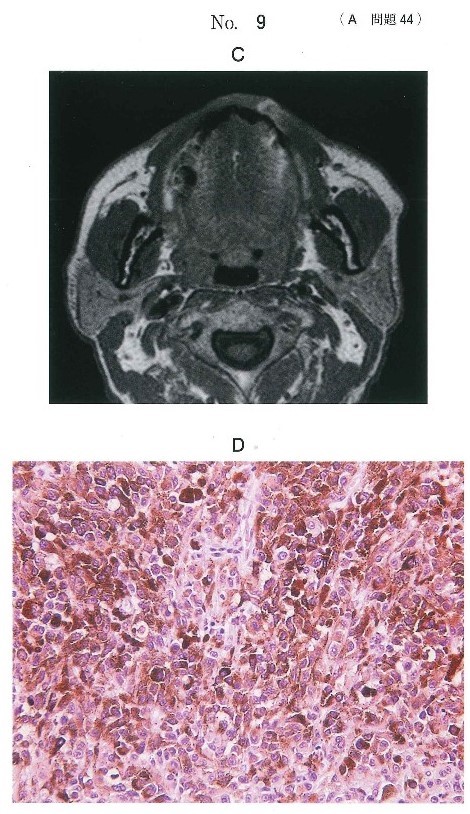 MRI T1強調像及び生検時のΗ-E染色病理組織像