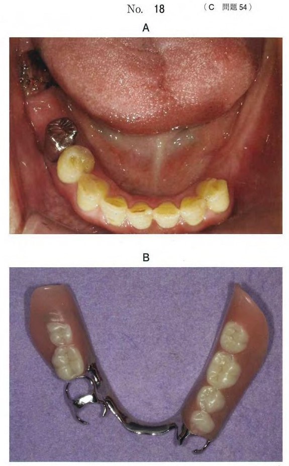 口腔内写真と下顎義歯の写真