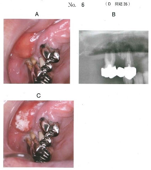 口腔内写真、エックス線画像、及びある薬液を用いた反応後の口腔内写真