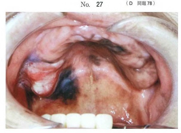 上顎悪性黒色腫の口腔内写真