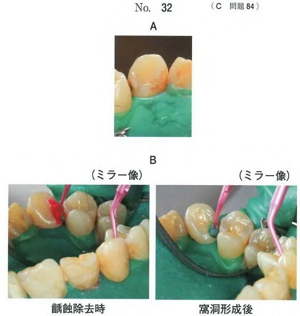 歯科医師国家試験 第115回 C84問題 | 歯科国試ドットコム