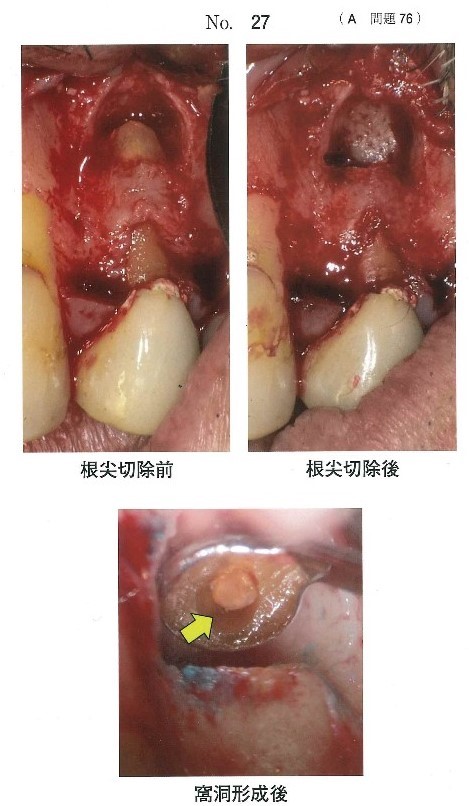 歯根尖切除時の口腔内写真