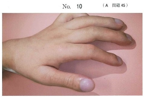 患者の手の写真