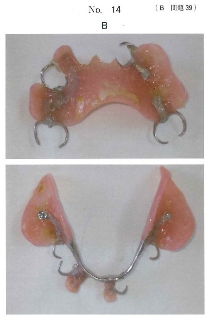 使用中の義歯の写真