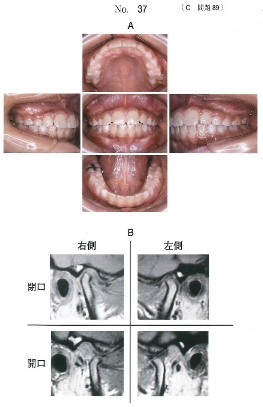初診時の口腔内写真と両側顎関節部MRI