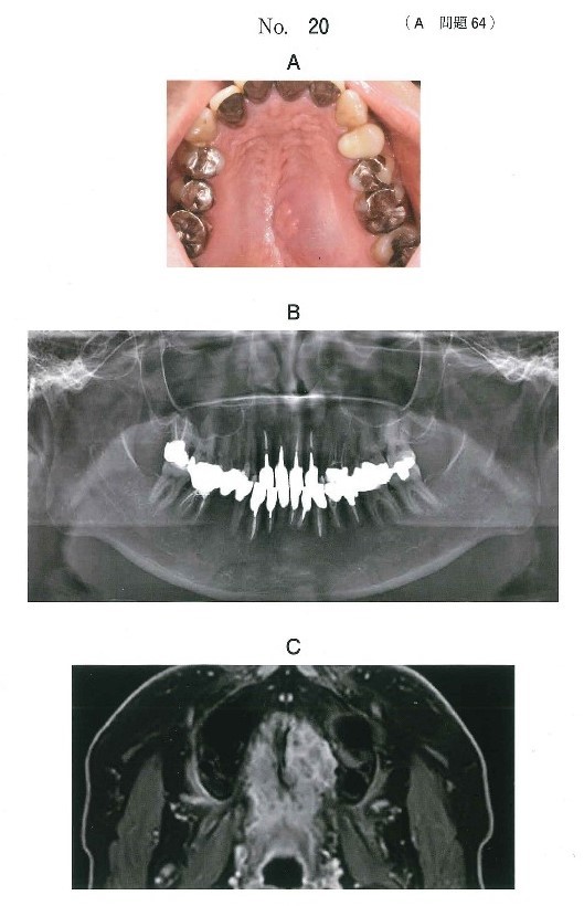 口腔内写真、エックス線画像、脂肪抑制造影MRI T1強調像、生検時のΗ-E染色病理組織像