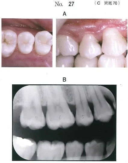 歯科医師国家試験 第116回 C70問題 | 歯科国試ドットコム