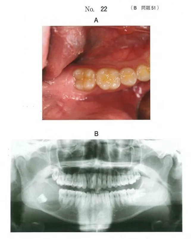 歯科医師国家試験 第115回 B51問題 | 歯科国試ドットコム